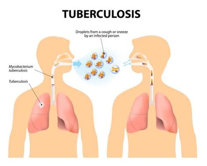 Image 1 is the TB