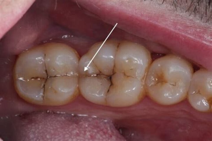 Right most tooth broken from the tongue